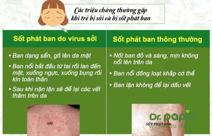 Sốt phát ban dạng sởi ở trẻ em: Dấu hiệu nhận biết, cách điều trị và phòng ngừa So sánh sốt phát ban dạng sởi với sốt phát ban thông thường