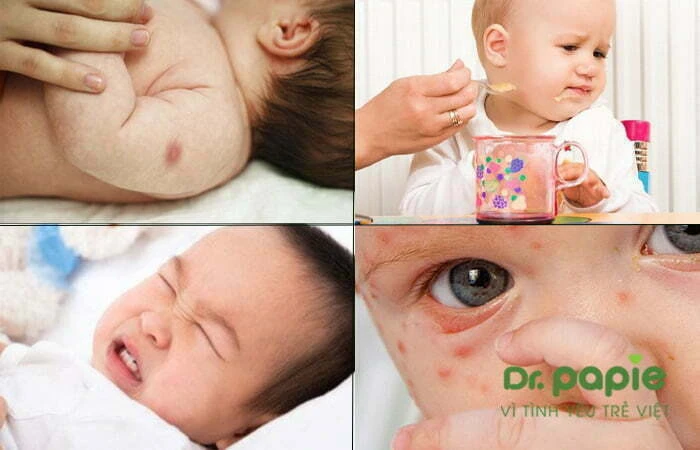 Sốt phát ban ở trẻ có lây không? Cách phòng ngừa đơn giản tại nhà Dấu hiệu bé bị sốt phát ban