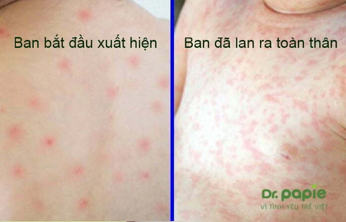 Sốt phát ban ở trẻ em bệnh học: Cơ chế bệnh sinh, chẩn đoán và cách điều trị Giai đoạn phát ban ở trẻ bị sốt phát ban
