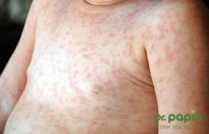 Sốt phát ban ở trẻ em có nguy hiểm không? 4 biến chứng thường gặp & Cách chăm sóc tại nhà sốt phát ban ở trẻ