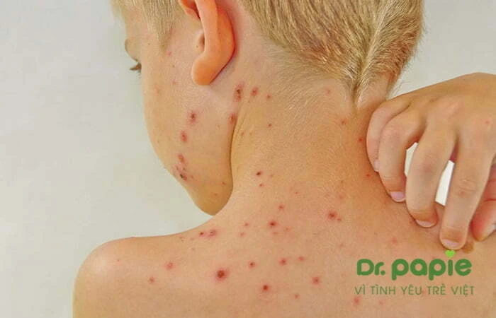 Sốt phát ban ở trẻ: Nguyên nhân, triệu chứng và cách điều trị Trẻ phát ban đỏ trên da