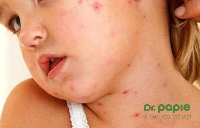 Sốt phát ban ở trẻ: Nguyên nhân, triệu chứng và cách điều trị Trẻ phát ban ở cổ