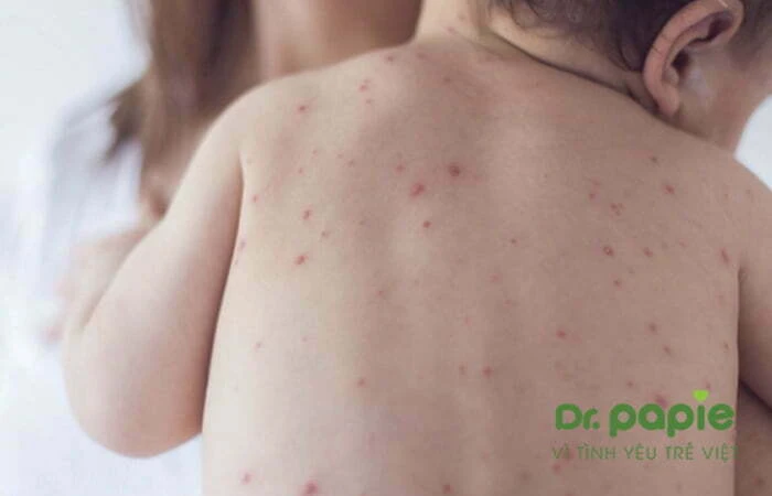 Sốt phát ban ở trẻ: Nguyên nhân, triệu chứng và cách điều trị Phát ban trên lưng bé