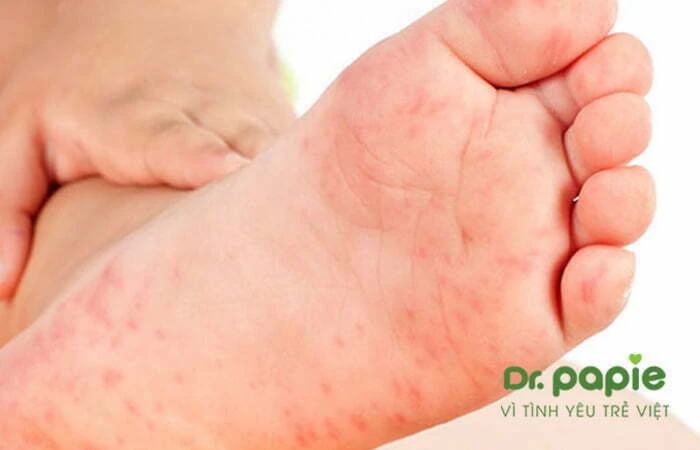 Sốt phát ban ở trẻ: Nguyên nhân, triệu chứng và cách điều trị Nốt phát ban trên chân bé
