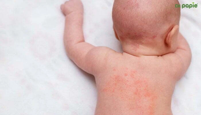 sot phat ban o tre so sinh bao lau thi khoi co nen tam khong