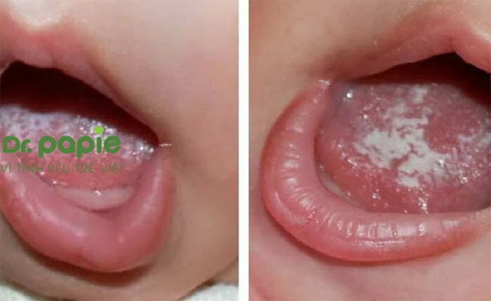Tất tần tật về nấm miệng ở trẻ em, nguyên nhân, dấu hiệu và cách điều trị nấm miệng ở trẻ em mẹ nên biết Nấm miệng ở trẻ em khiến trẻ bị nứt ở khóe miệng