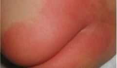 Trẻ bị hăm bỉm - Những điều quan trọng mẹ cần biết  Hăm bỉm cấp độ 4