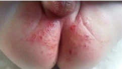 Trẻ bị hăm bỉm - Những điều quan trọng mẹ cần biết  Hăm bỉm cấp độ 5