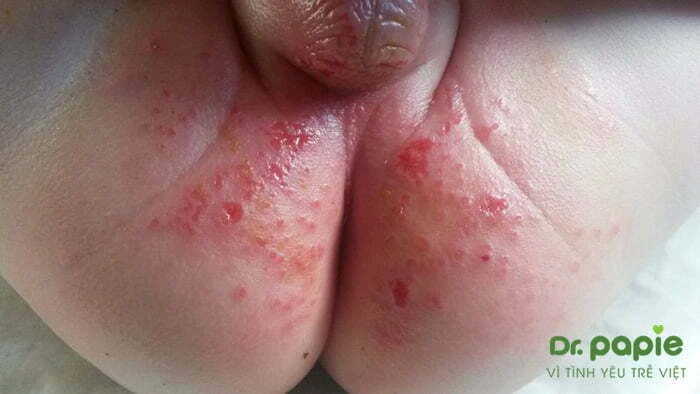 Trẻ bị hăm tã mùa hè nặng, có mủ