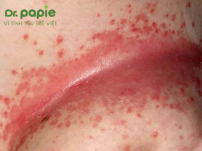 Trẻ bị hăm tã phải làm sao? 5 cách trị và 6 việc cần làm NGAY tre bi ham ta phai lam sao 5 cach tri va 6 viec can lam ngay