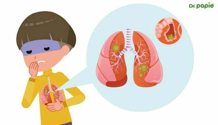 Trẻ bị nôn không sốt là dấu hiệu của bệnh gì? Trẻ bị nôn là dấu hiệu bệnh gì