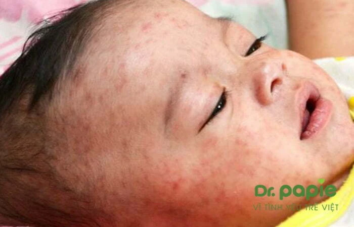Trẻ bị phát ban sau khi sốt mọc răng có nguy hiểm không? nguyên nhân và cách chăm sóc Trẻ mọc răng sốt phát ban