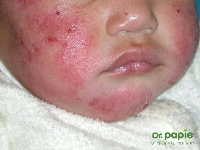 Trẻ bị viêm da cơ địa có tiêm phòng được không và cần lưu ý gì trước khi tiêm Trẻ bị viêm da cơ địa