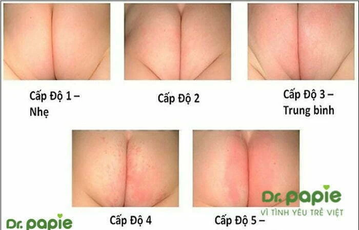 Trẻ hăm tã nặng: Nguyên nhân và cách điều trị an toàn, hiệu quả 5 cấp độ của hăm tã