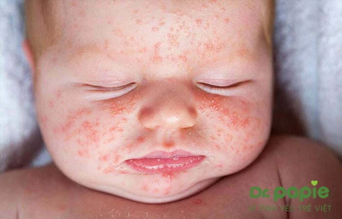 Trẻ nổi rôm sảy trên mặt: 5 nguyên nhân & 4 cách trị không để lại sẹo Bé bị rôm sảy trên mặt