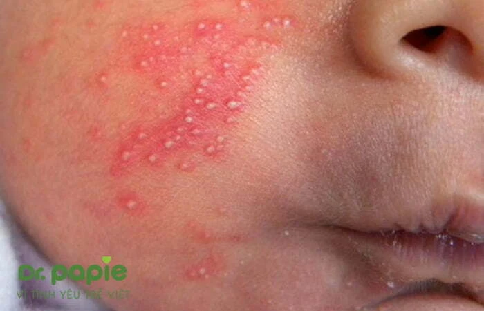 Trẻ nổi rôm sảy trên mặt: 5 nguyên nhân & 4 cách trị không để lại sẹo Rôm sảy ở mặt phát triển nặng