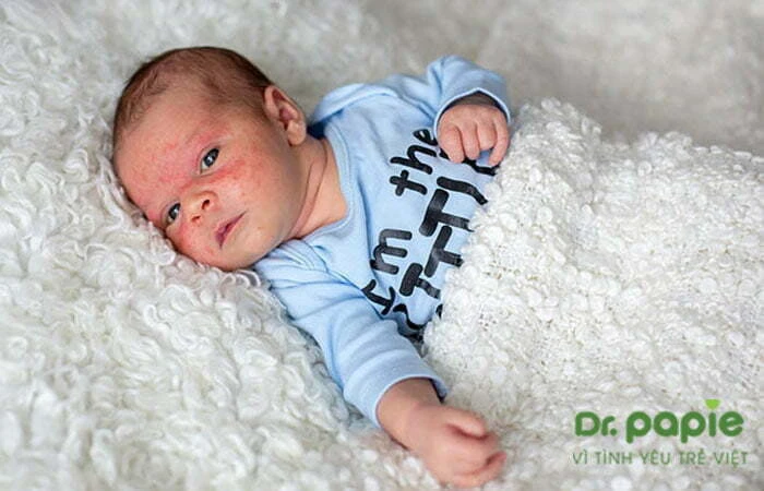 trẻ phát ban sau sốt 
