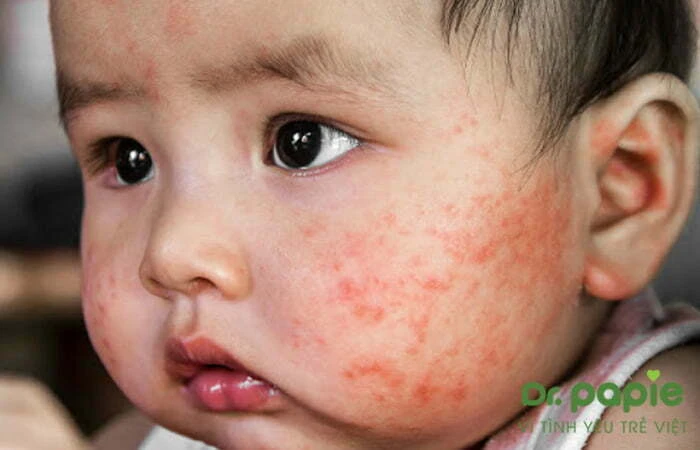 trẻ phát ban sau sốt