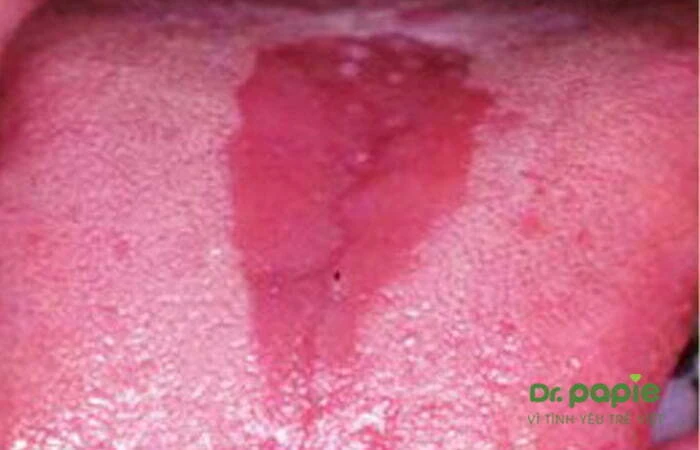 Trẻ phát ban sau sốt: nguyên nhân và chăm sóc giúp trẻ nhanh khỏi Lưỡi trẻ sốt phát ban trắng do nhiễm khuẩn