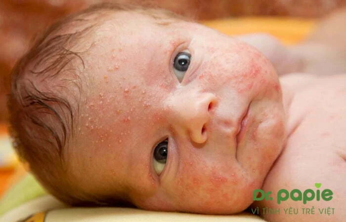 Trị rôm sảy bằng kinh giới hiệu quả và an toàn với làn da của bé Bé bị rôm sảy nặng