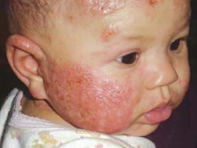 Viêm da cơ địa ở trẻ nhỏ nguyên nhân và triệu chứng viem da co dia o tre nho nguyen nhan va trieu chung 1