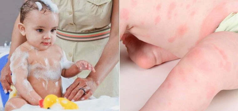 Viêm da cơ địa ở trẻ và những điều chưa biết Tránh xa các loại sữa tắm có bọt và chất tẩy rửa>