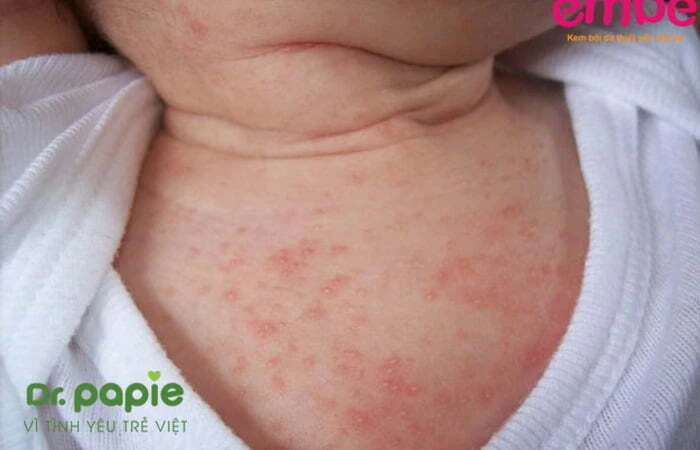 Bé bị chàm sữa ở cổ: Nguyên nhân, triệu chứng và cách điều trị Ảnh vết bong vảy