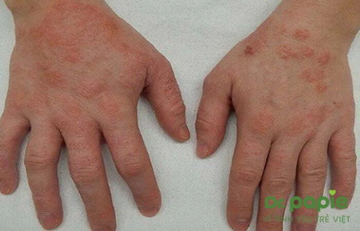Viêm da cơ địa trẻ sơ sinh: nguyên nhân, triệu chứng & cách phòng ngừa viêm da cơ địa ở tay trẻ sơ sinh