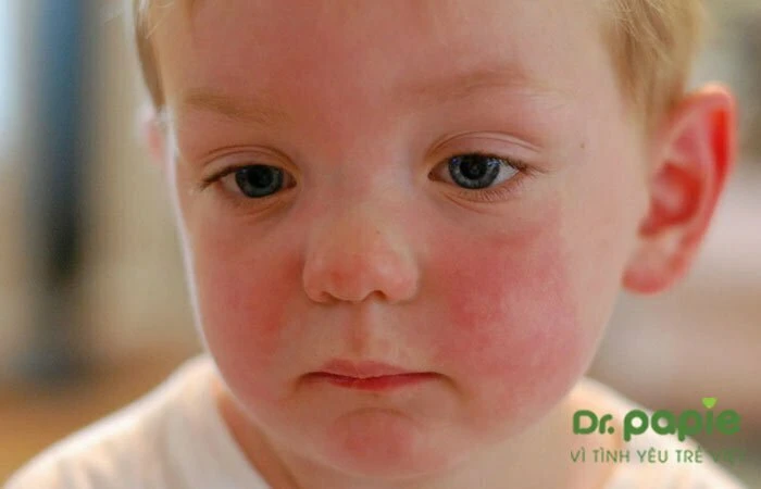 Viêm da cơ địa trẻ sơ sinh: nguyên nhân, triệu chứng & cách phòng ngừa Trẻ bị viêm da cơ địa