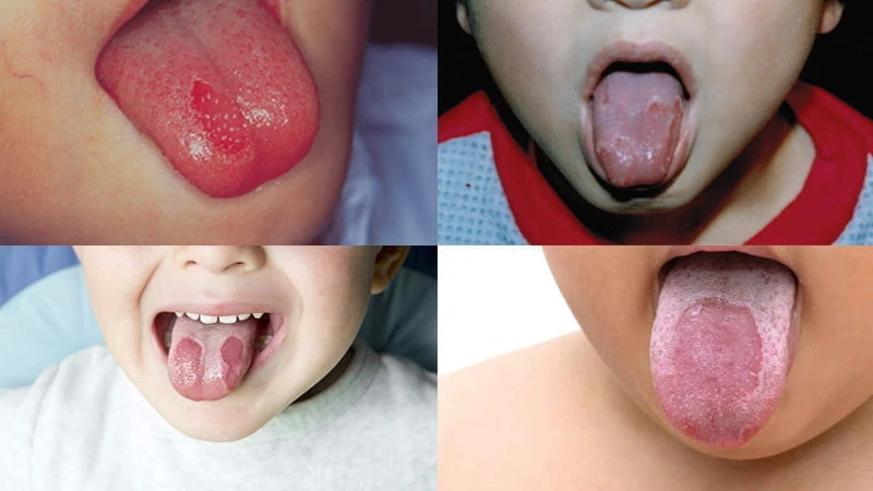 Hình ảnh nhận biết trẻ bị viêm lưỡi bản đồ Hình ảnh nhận biết trẻ bị viêm lưỡi bản đồ