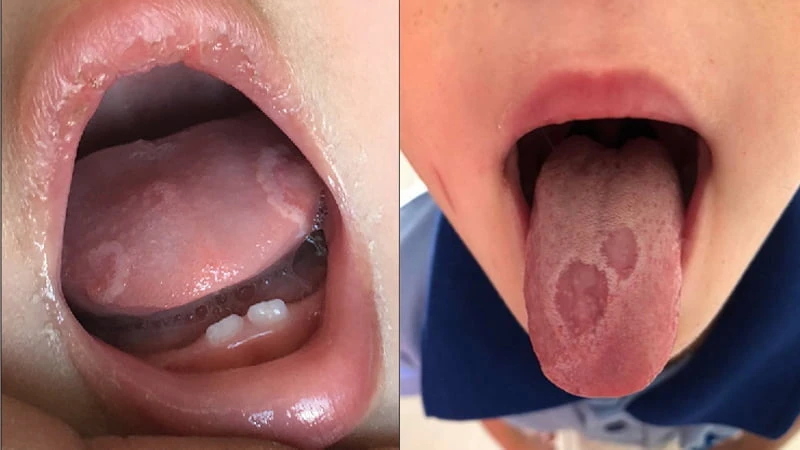 Hình ảnh trẻ bị viêm lưỡi bản đồ Hình ảnh trẻ bị viêm lưỡi bản đồ