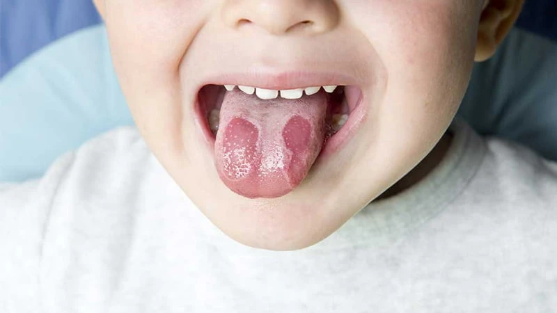 Viêm lưỡi bản đồ ở trẻ em: cách điều trị và phòng tránh hiệu quả viem luoi ban do o tre em cach dieu tri va phong tranh hieu qua